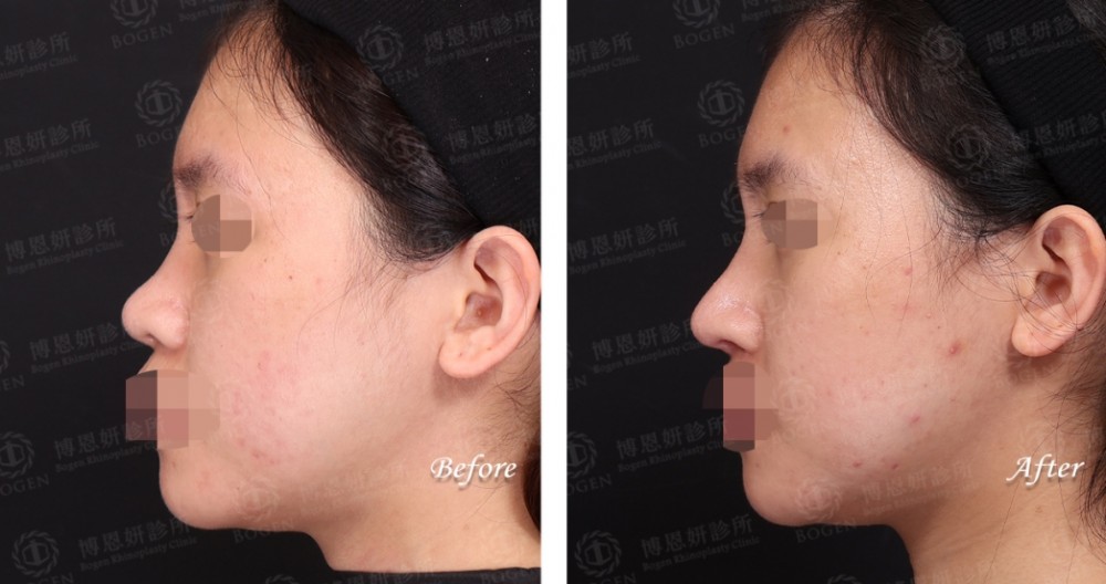 隆鼻術後口服A酸消腫更快,隆鼻與口服A酸,博恩妍